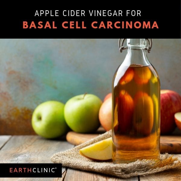 Apple Cider Vinegar for Basal Cell Carcinoma.