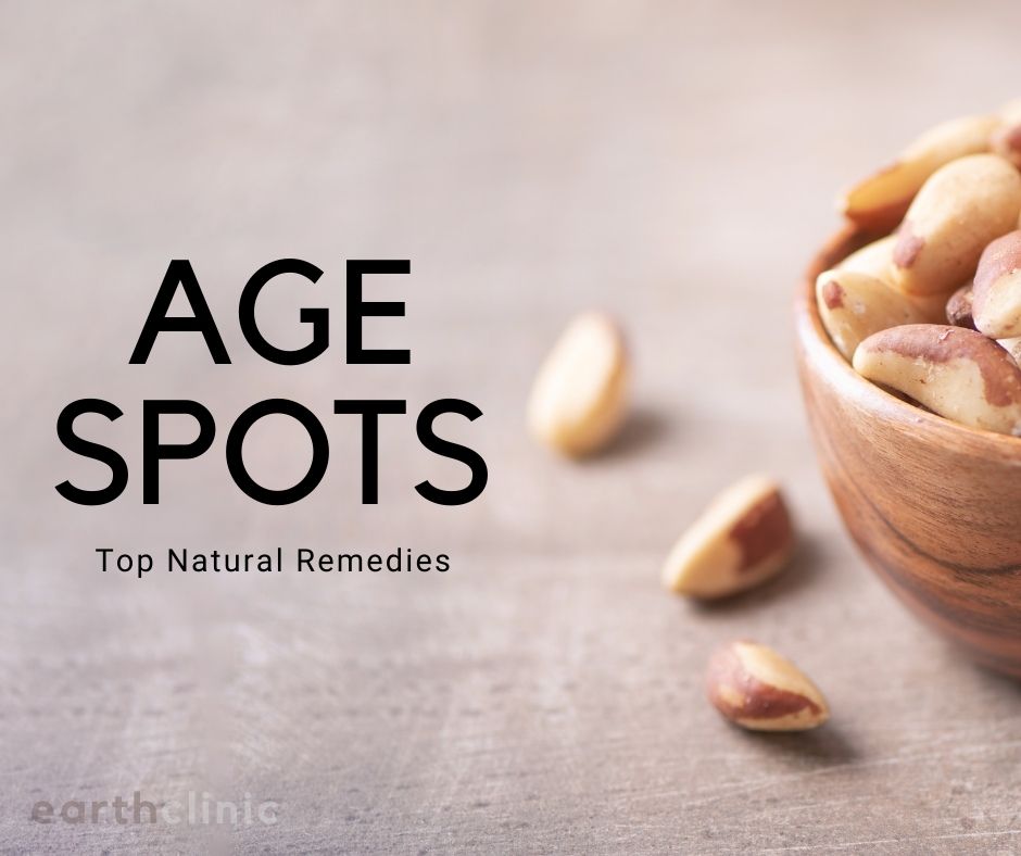 Age Spot Remedies