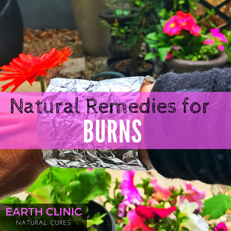 Natural Remedies for Burns