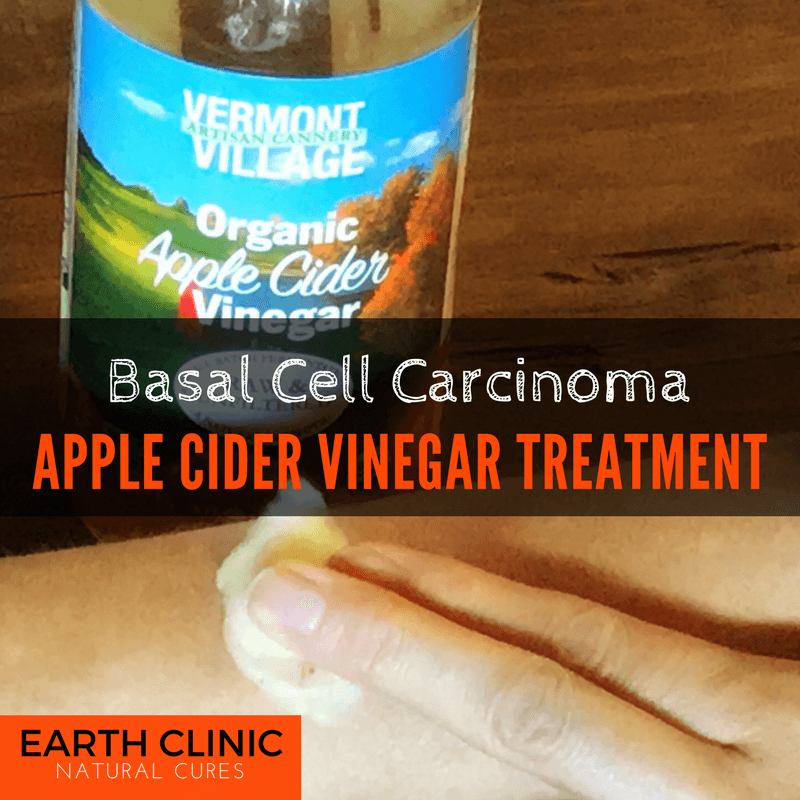 Apple Cider Vinegar Basal Cell Photos