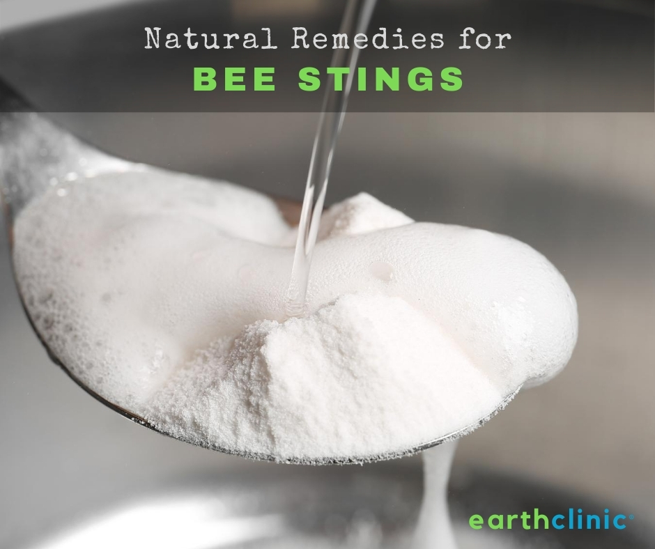 Bee Sting Remedies