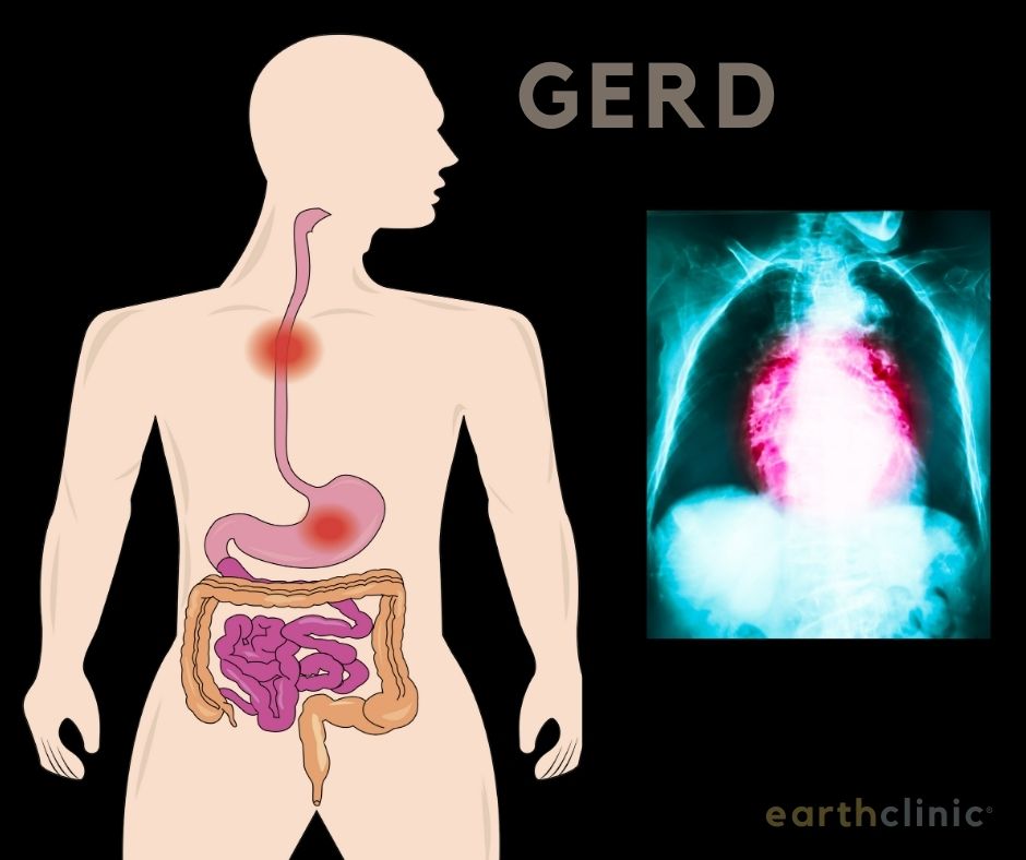 Gerd - Low Stomach Acid