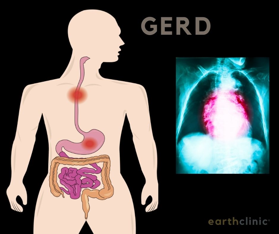 Gerd Remedies