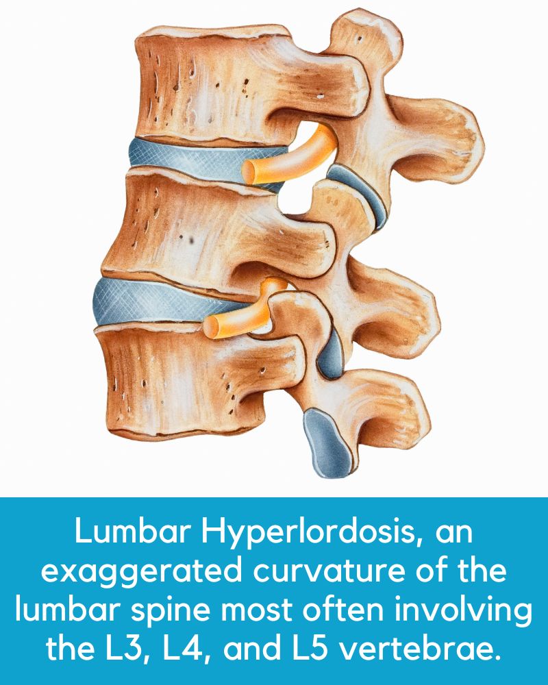 Hyperlordosis