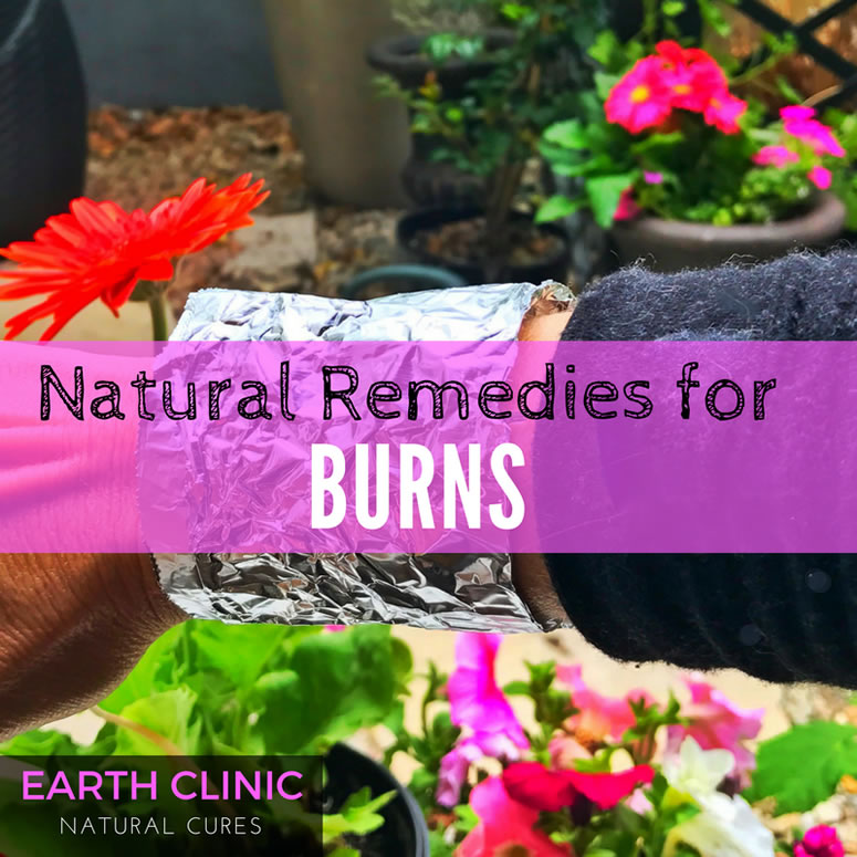 Effective Natural Remedies for Burns