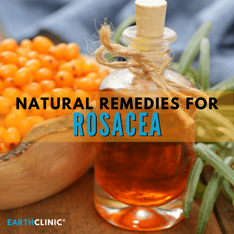 Natural Remedies for Rosacea