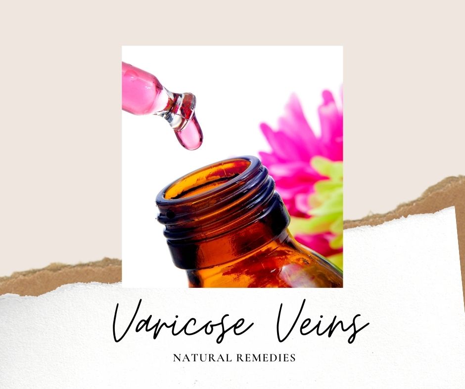 Varicose Vein Remedies