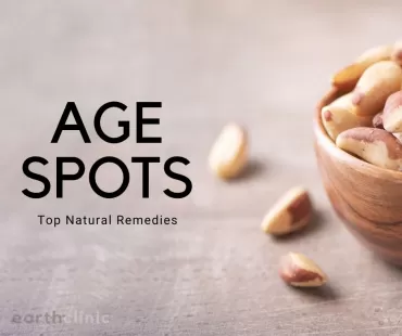 Age Spot Remedies